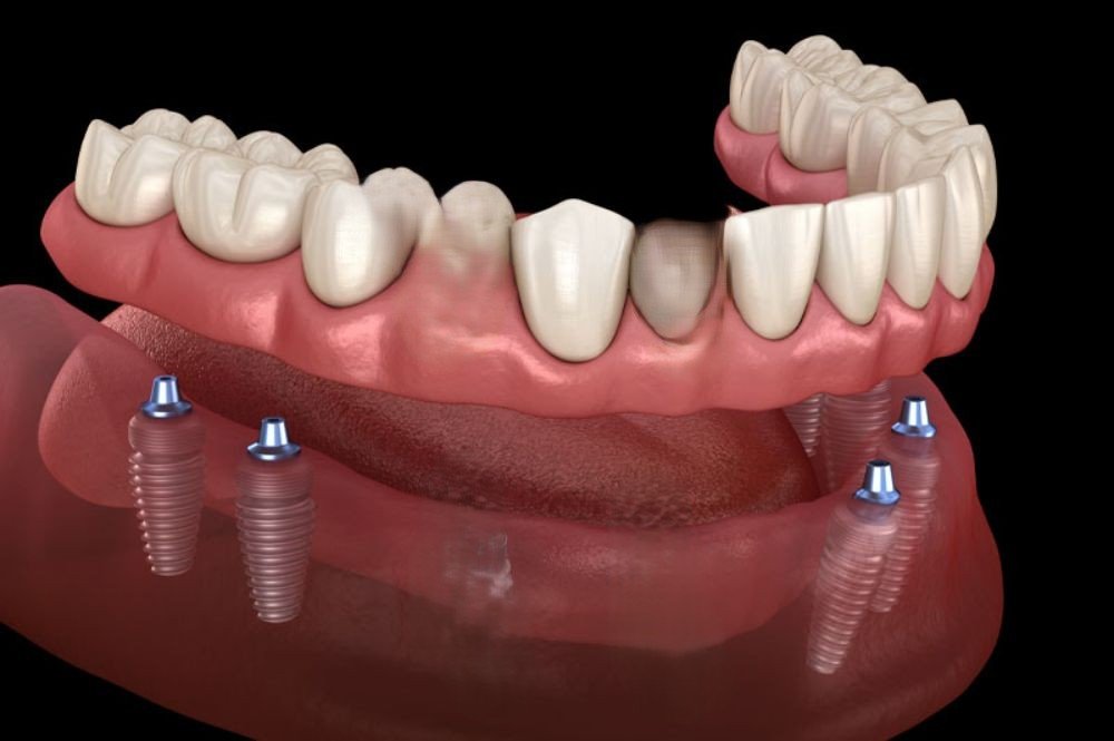 Full mouth rehabilitation