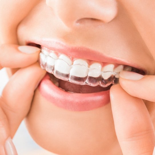 Invisible aligners