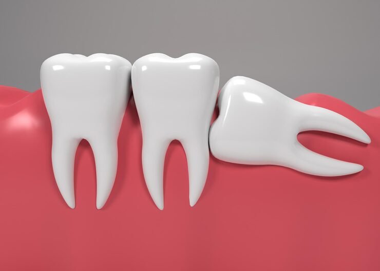 Wisdom tooth extraction